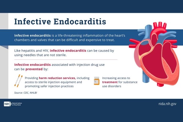 Basic information on infective endocarditis and injection drug use